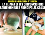 hijama et circoncision